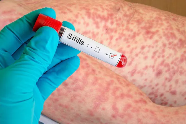 Primul test pentru depistarea Sifilis la domiciliu, autorizat în SUA