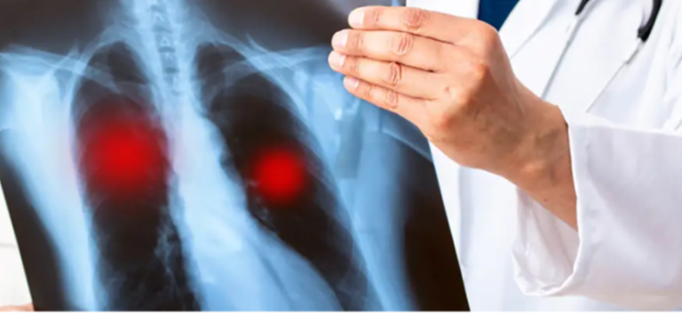 Tuberculoza devine principala cauză de deces infecțios în 2023, depășind COVID-19 și evidențiind nevoia urgentă de acțiune globală