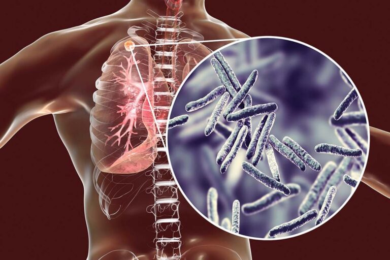România, țara cu cea mai mare incidență a tuberculozei din UE: progrese importante, dar provocări persistente